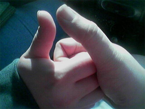 Bent thumb.